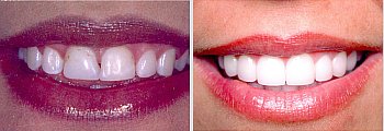 Before and After shot