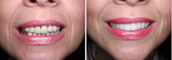 Before and After shot