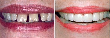 Before and After shot