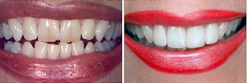 Before and After shot