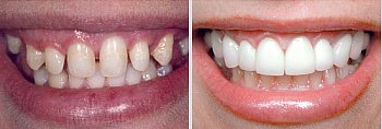 Before and After shot